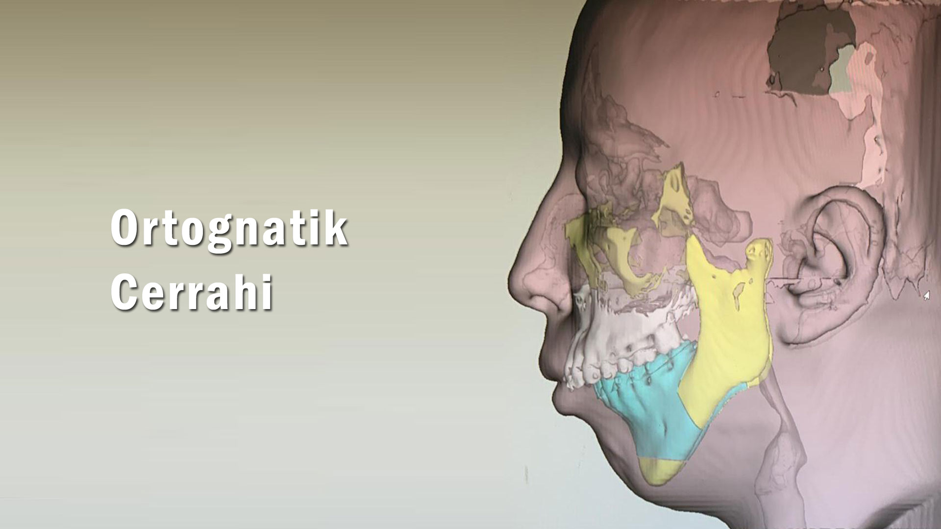 Ortognatik Cerrahi