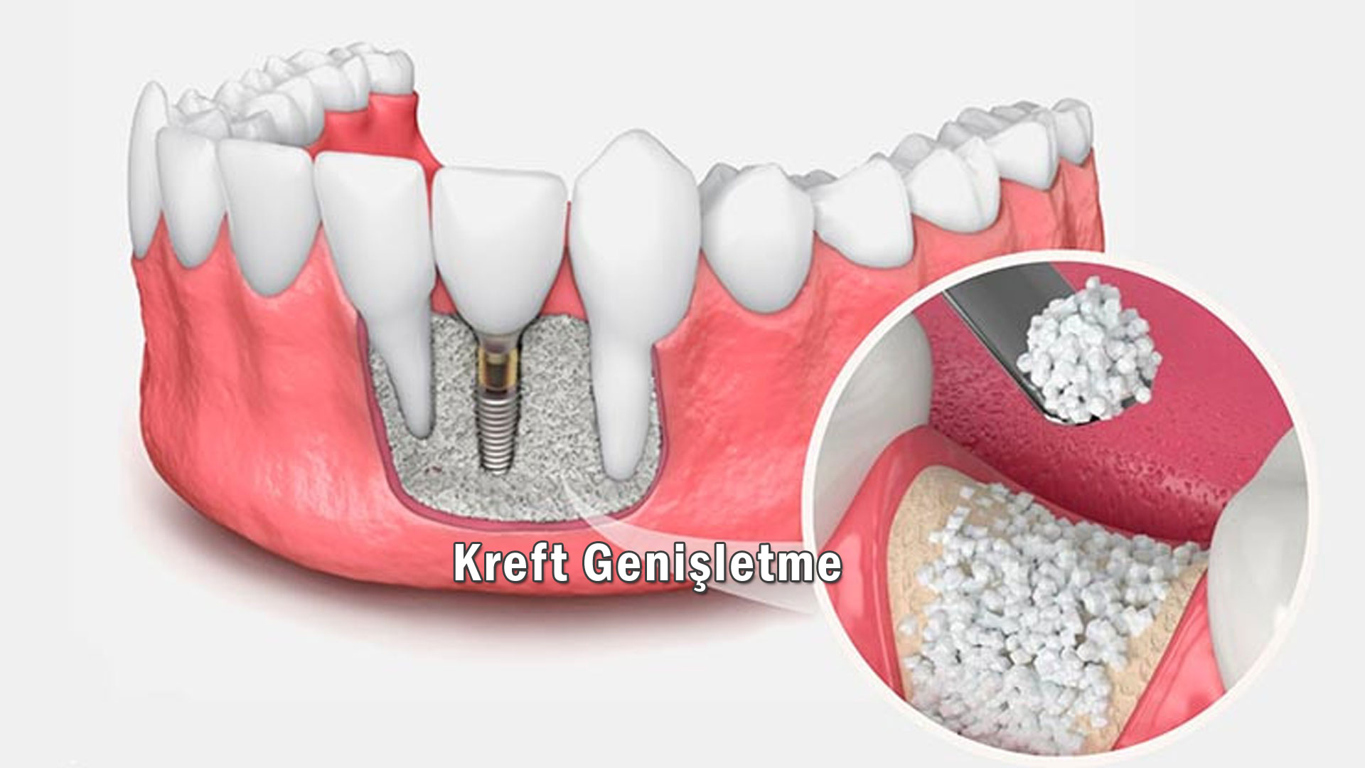 Kret Genişletme
